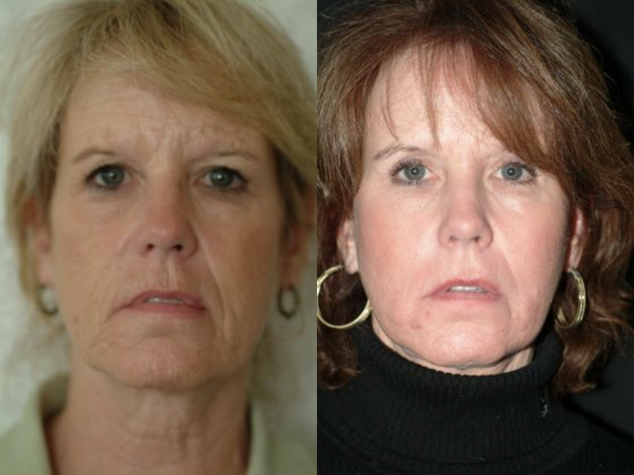 Before & After Results at The Center for Cosmetic Medicine | Decatur, IL