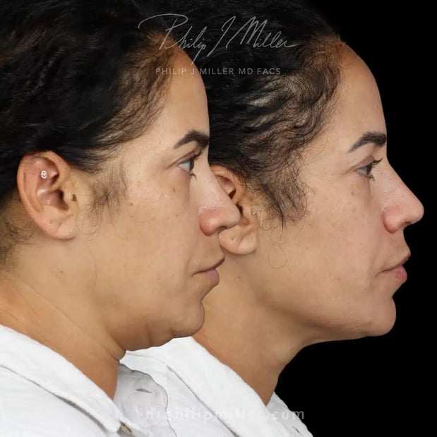 Images Dr. Philip Miller - #1 Facelift and Rhinoplasty Surgeon in New York