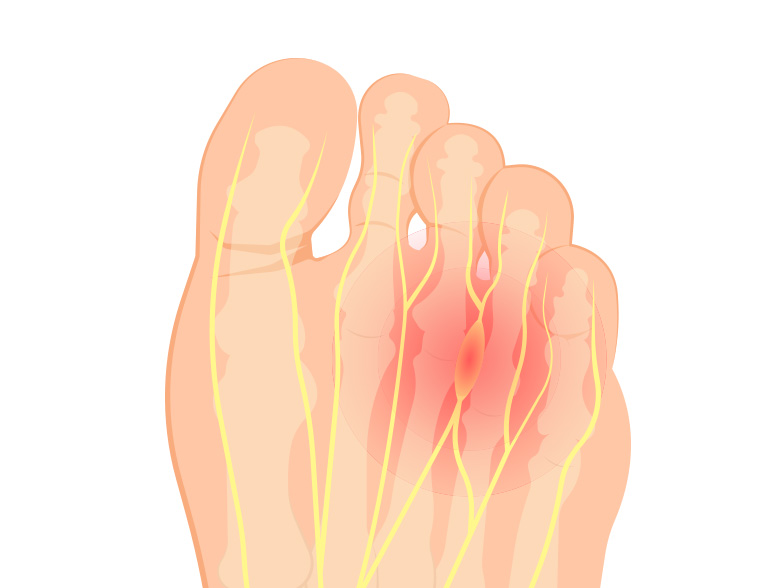 Cncrns_Cndtns-footpain-nerve392x294@2x.jpg