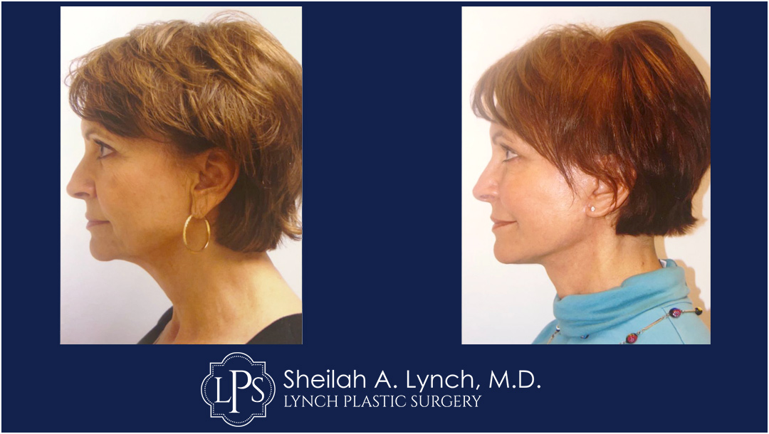 Neck Lift Before & After Patient Chevy Chase Maryland. Plastic Surgeon Near Me Sheilah A. Lynch, MD