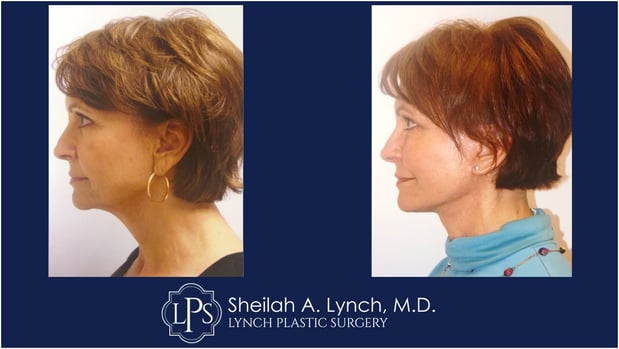 Images Sheilah A. Lynch, MD - Lynch Plastic Surgery