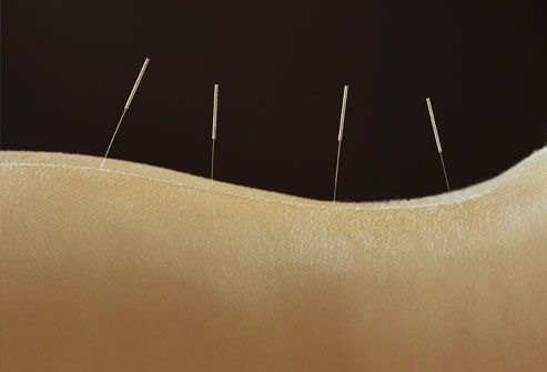 We offer acupuncture at Winter Park Chiropractic & Acupuncture
