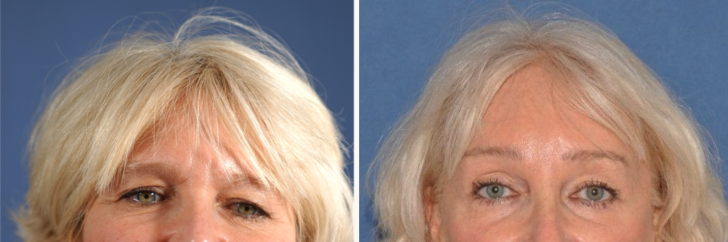 17 year follow up on Brow Lift Before & After at Clinic of Facial Plastic Surgery | Buffalo, NY