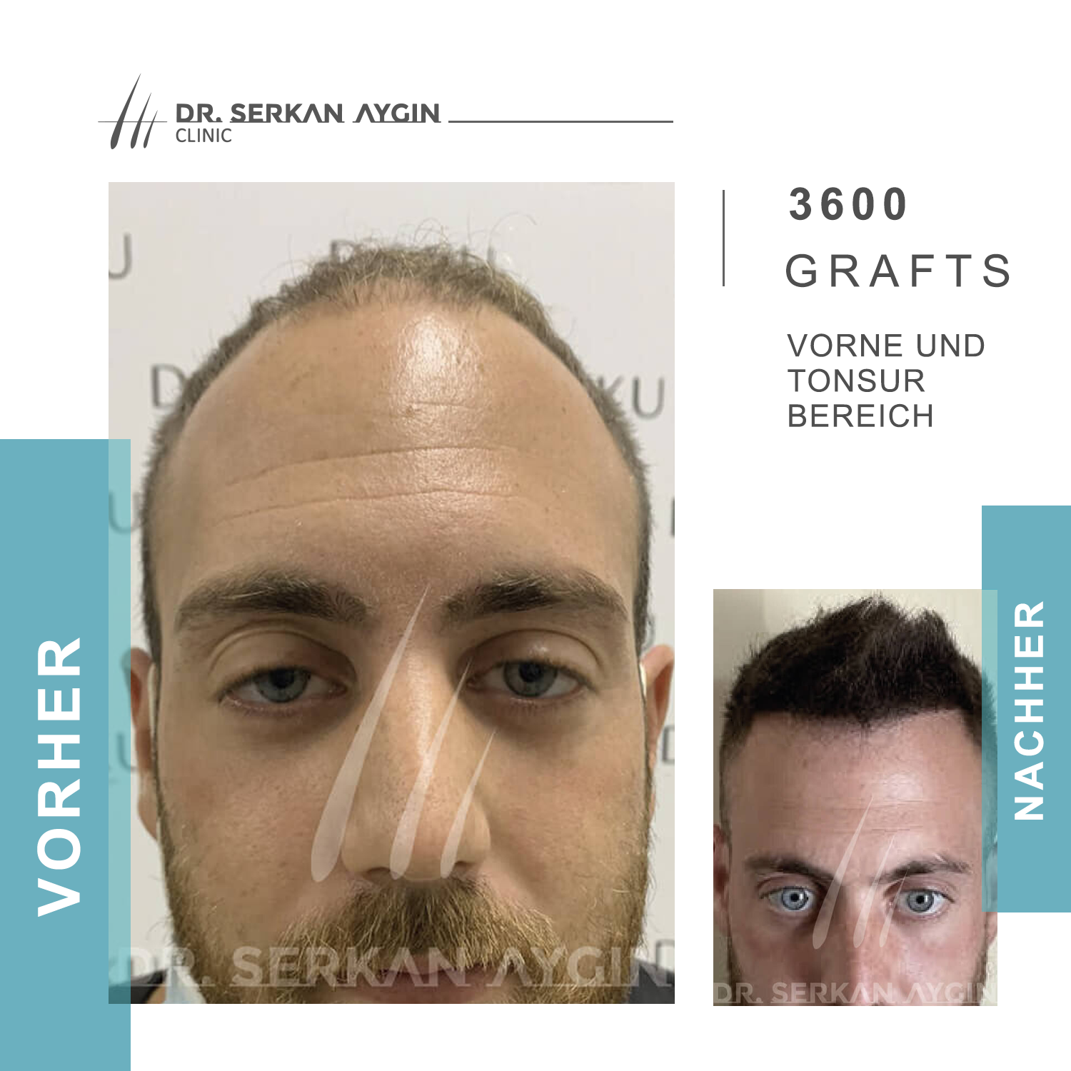 Kundenbild groß 7 Dr Serkan Aygin | Niederlassung Berlin | Haartransplantation Türkei