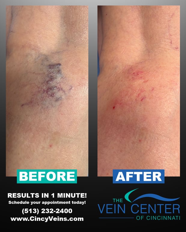 Images The Vein Center of Cincinnati, LLC