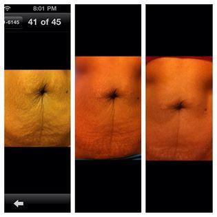 Anyone can take care of the extra flesh on the stomach with our non invasive tummy tuck with micro current and the Beautiful Image application.