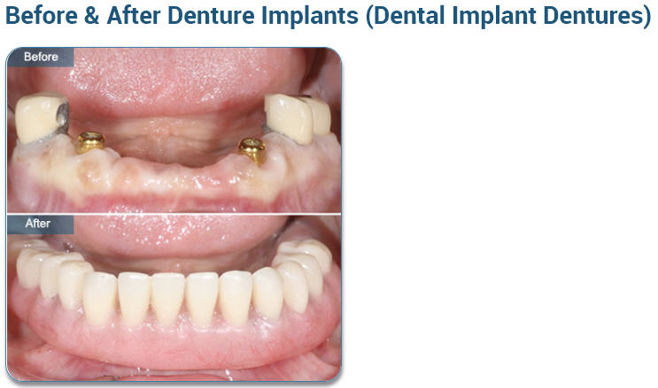 Before & After Denture Implants (Dental Implant Dentures)