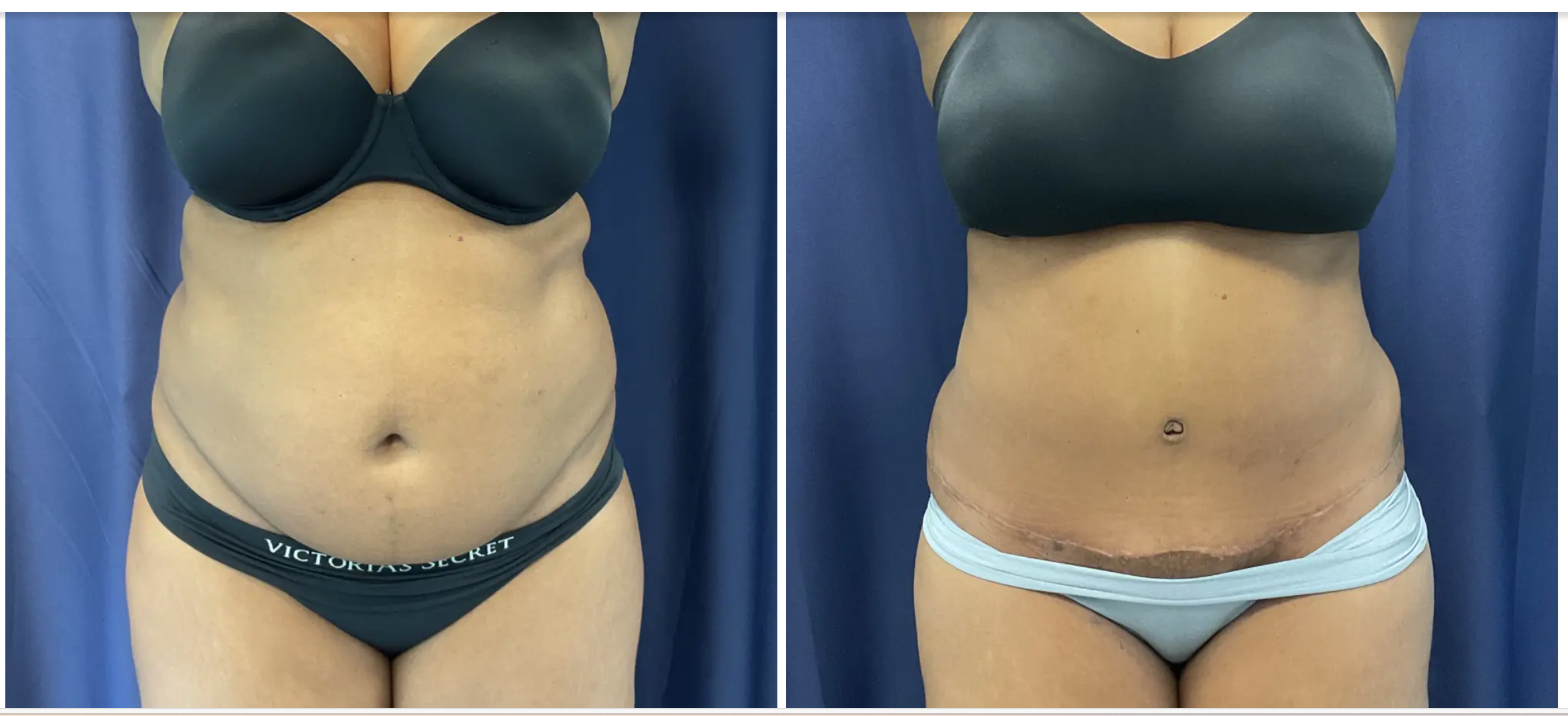 Columbia Aesthetic Plastic Surgery Tummy Tuck