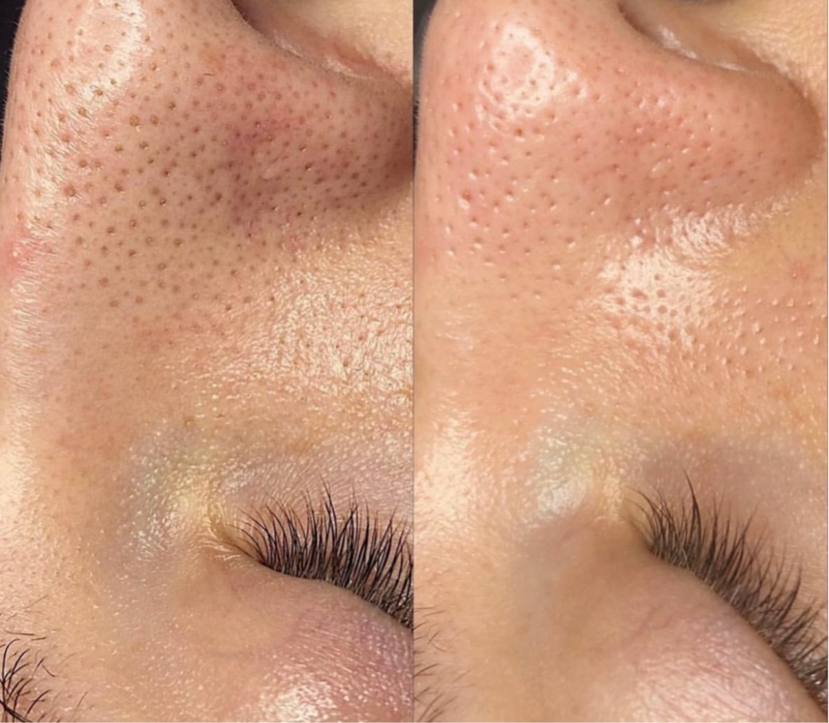 Hydrafacial before and after close-up at KWJ Skin Clinic, a skin and aesthetic clinic in Broadbridge Heath, Horsham, showing improved skin texture, hydration, pores and glow.