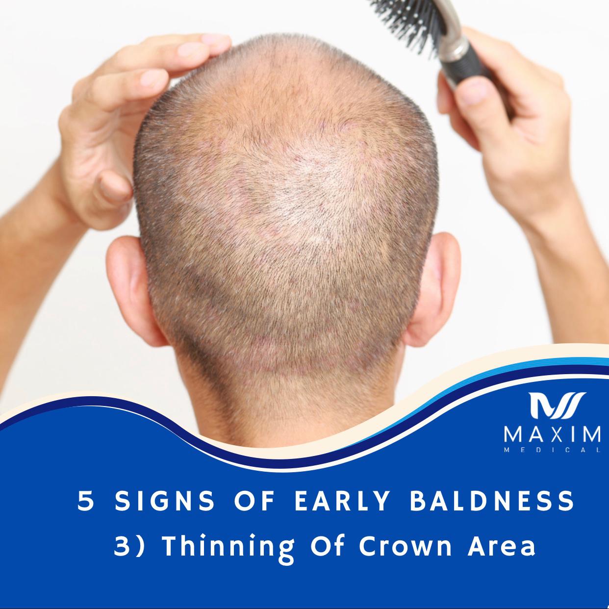 5 Early Signs You May Be Going Bald

3. Thinning Of Crown Area
Another common characteristic of Male Pattern Baldness is if you notice thinning in the crown area of your hair. Aside from your frontal hairline and temple area, the crown is a main result of MPB. In many cases this can occur even before thinning hair in front. Not all people go bald from their hairline. Some men experience what's called diffuse thinning. This is a type of hair loss that either affects the entire scalp or specific areas like the crown...