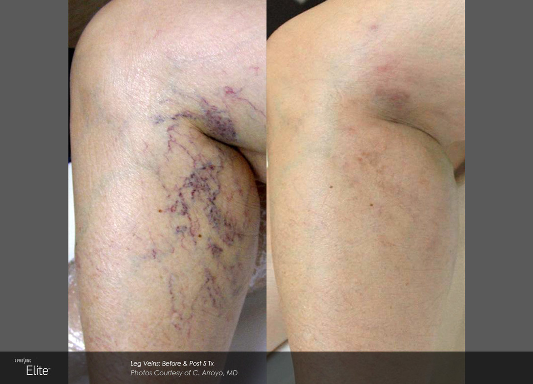Images Onyx Esthétique - Soins esthétiques, Soins de la peau, Laser Cynosure Gatineau