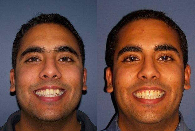 Before & After from Kellyn Hodges Orthodontics | Bensalem, PA