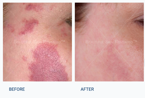 Before and After | Birthmarks at Dermatology & Laser Surgery Center
