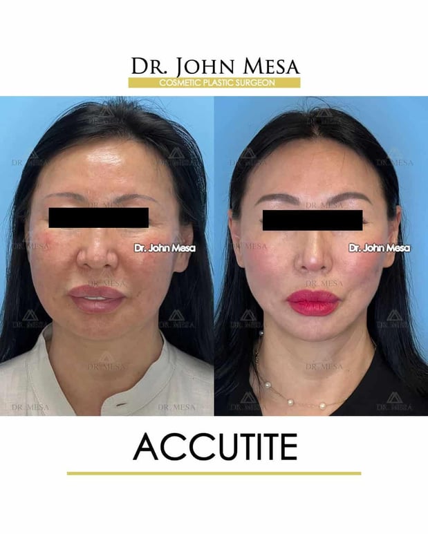Images Dr. John Mesa, MD: Plastic Surgeon NYC, Buccal Fat Removal, Chin Liposuction, Facelift, Facial Masculinization, Chin Implant