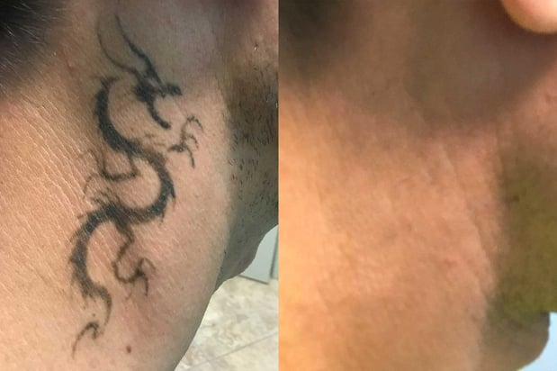 Images TakeTatt Tattoo Removal