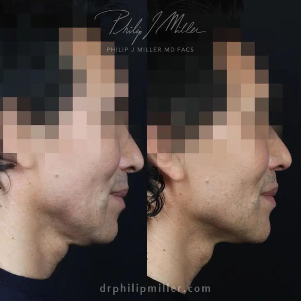 Images Dr. Philip Miller - #1 Facelift and Rhinoplasty Surgeon in New York