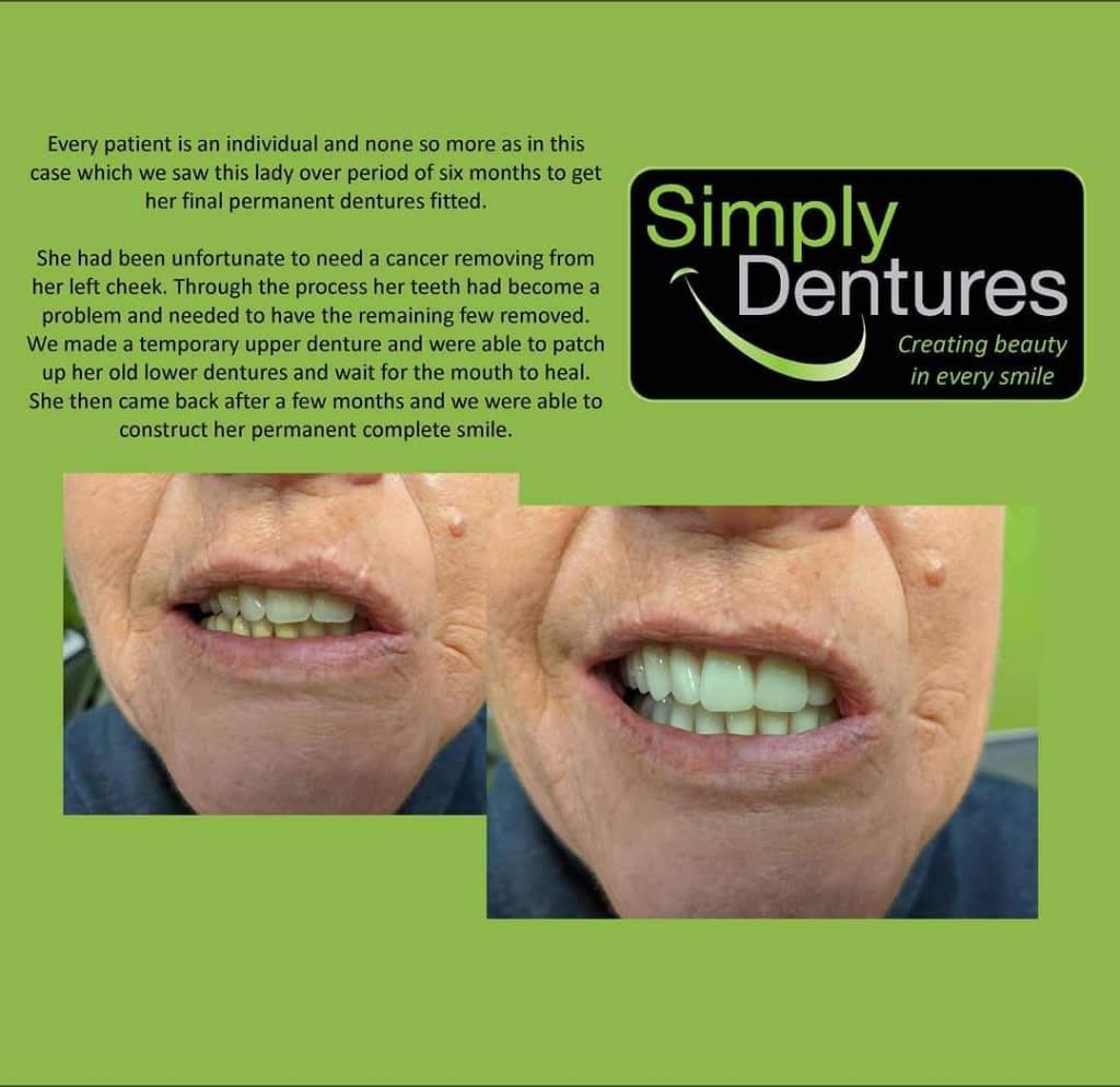 Simply Dentures Bilston 01902 664634