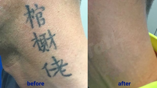 Images TakeTatt Tattoo Removal