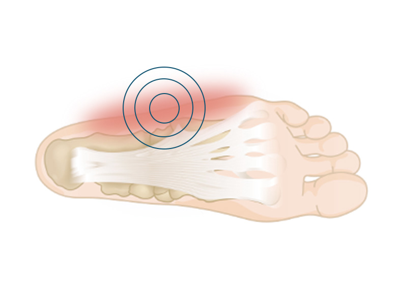 Cncrns_Cndtns-footpain-outside-392x294@2x.jpg