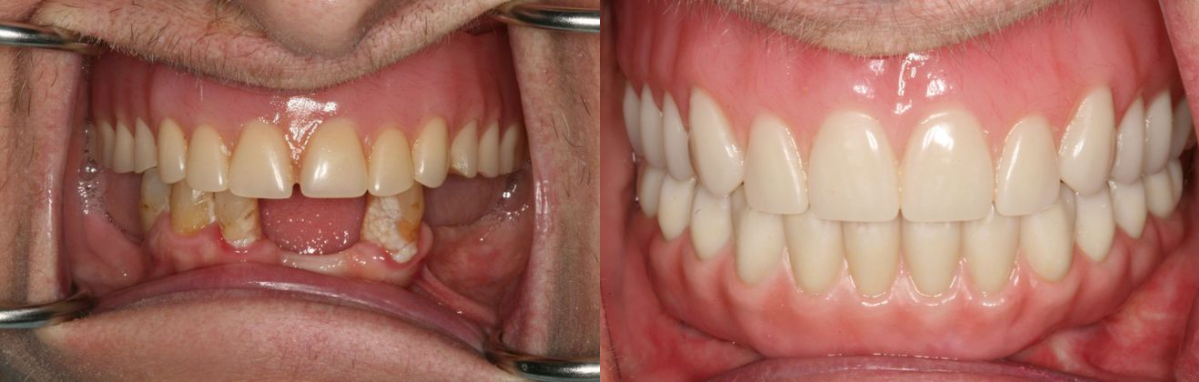 Before & After from Advanced Cosmetic and Implant Dentistry | Glastonbury, CT