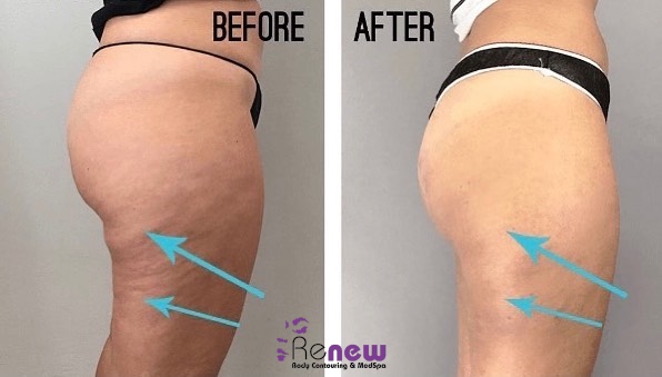 Images Renew Body Contouring & MedSpa