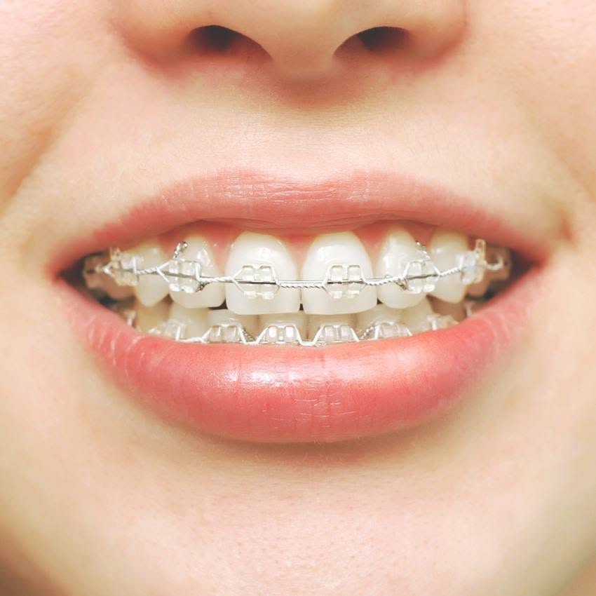 Close-up of clear orthodontic braces used to help improve tooth alignment as part of orthodontic car 