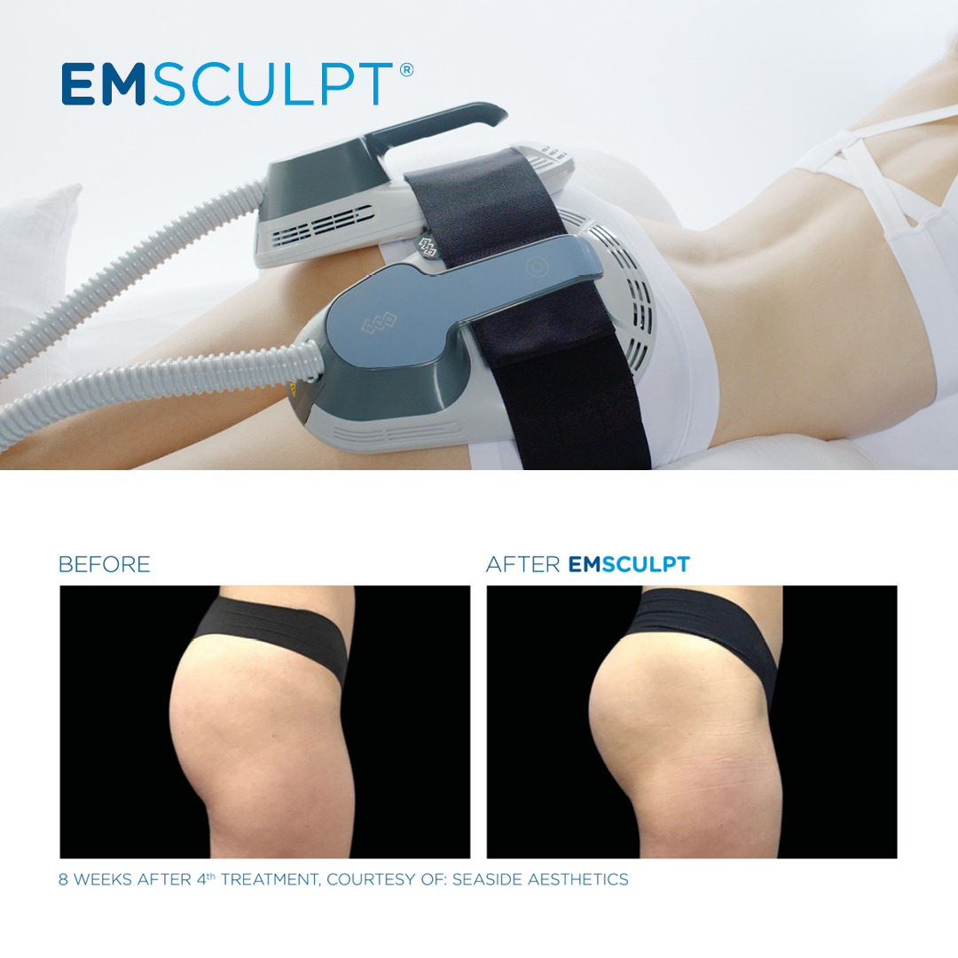 Non-invasive, non-surgical body sculpting for as low as $200 per session...less than a personal trainer and no sweat required. Book your FREE session and consult today @ https;//columbusemsculpt.com