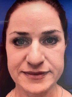 Images NP Aesthetics Las Vegas