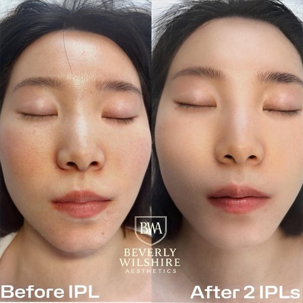 Images Beverly Wilshire Aesthetics Beverly Hills Medical Spa for Botox, Morpheus8, IPL, Lip Fillers