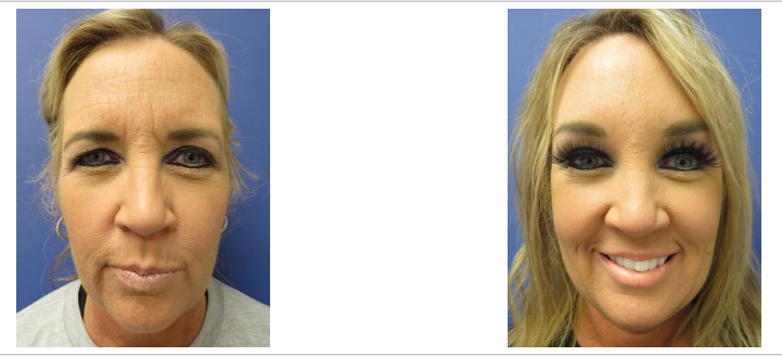 Before & After Results at Devlin Cosmetic Surgery: Michael Devlin, M.D. | Little Rock, AR