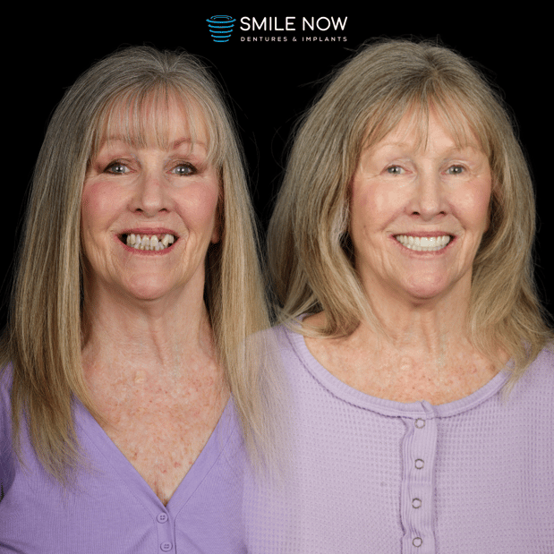 Images Smile Now Milwaukee Dentures and Implants