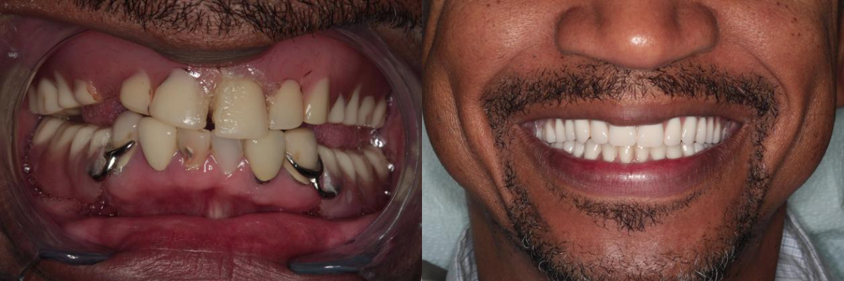 Before & After from Southern Dental Implant Center | Cordova, TN