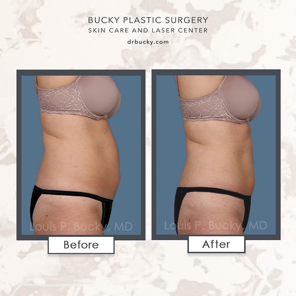 Coolsculpting patient before and after photo. Louis P. Bucky, MD, FACS Philadelphia (215)829-6320