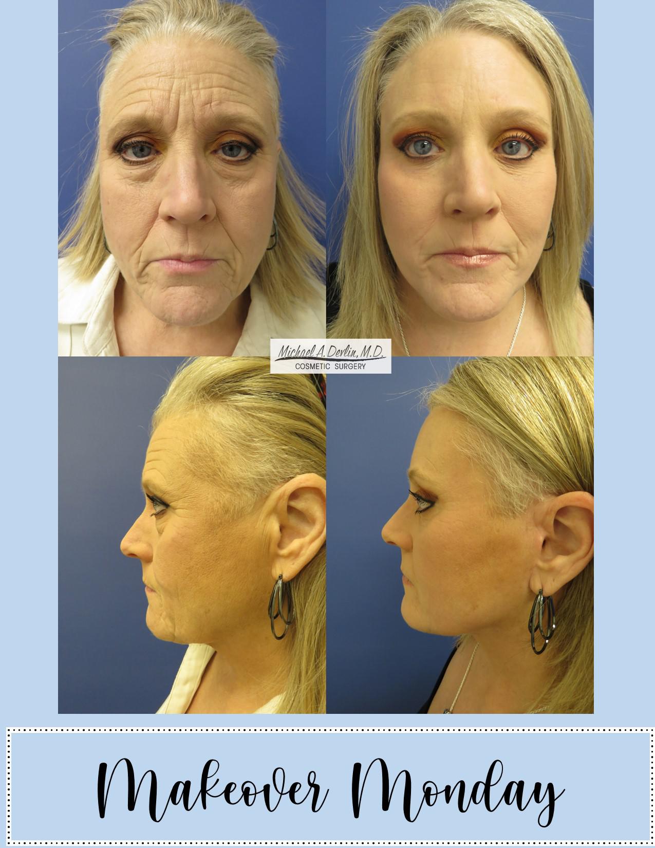 Before & After Results at Devlin Cosmetic Surgery: Michael Devlin, M.D. | Little Rock, AR