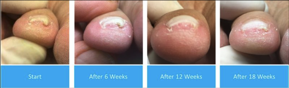 Before & After from Advanced Foot & Ankle Specialists | Avon, CT