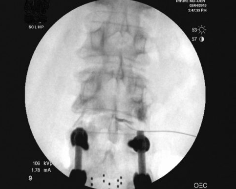 Proper intra-discal placement of stem cells at the level above a prior fusion. Excellent nuclear spread of contrast is noted.