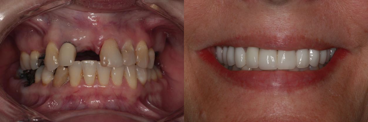 Before & After from Southern Dental Implant Center | Cordova, TN