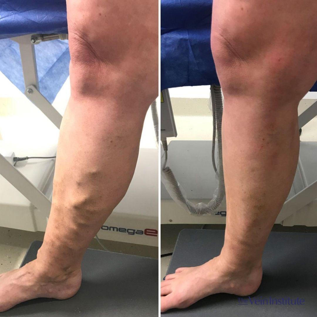 Images The Vein Institute Sydney - Varicose Vein Specialists