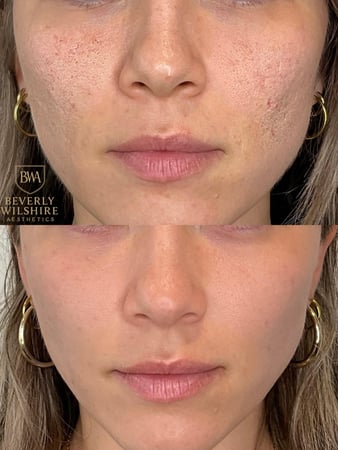Images Beverly Wilshire Aesthetics Beverly Hills Medical Spa for Botox, Morpheus8, IPL, Lip Fillers