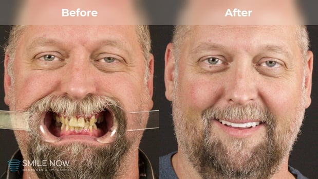 Images Smile Now Milwaukee Dentures and Implants