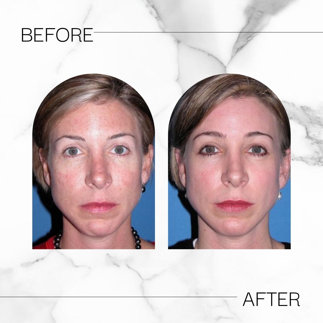 Before & After chemical peel results at Devlin Cosmetic Surgery: Michael Devlin, M.D. | Little Rock, AR