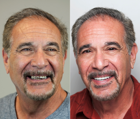 Before and After from Stubbs Dental | Murray, UT