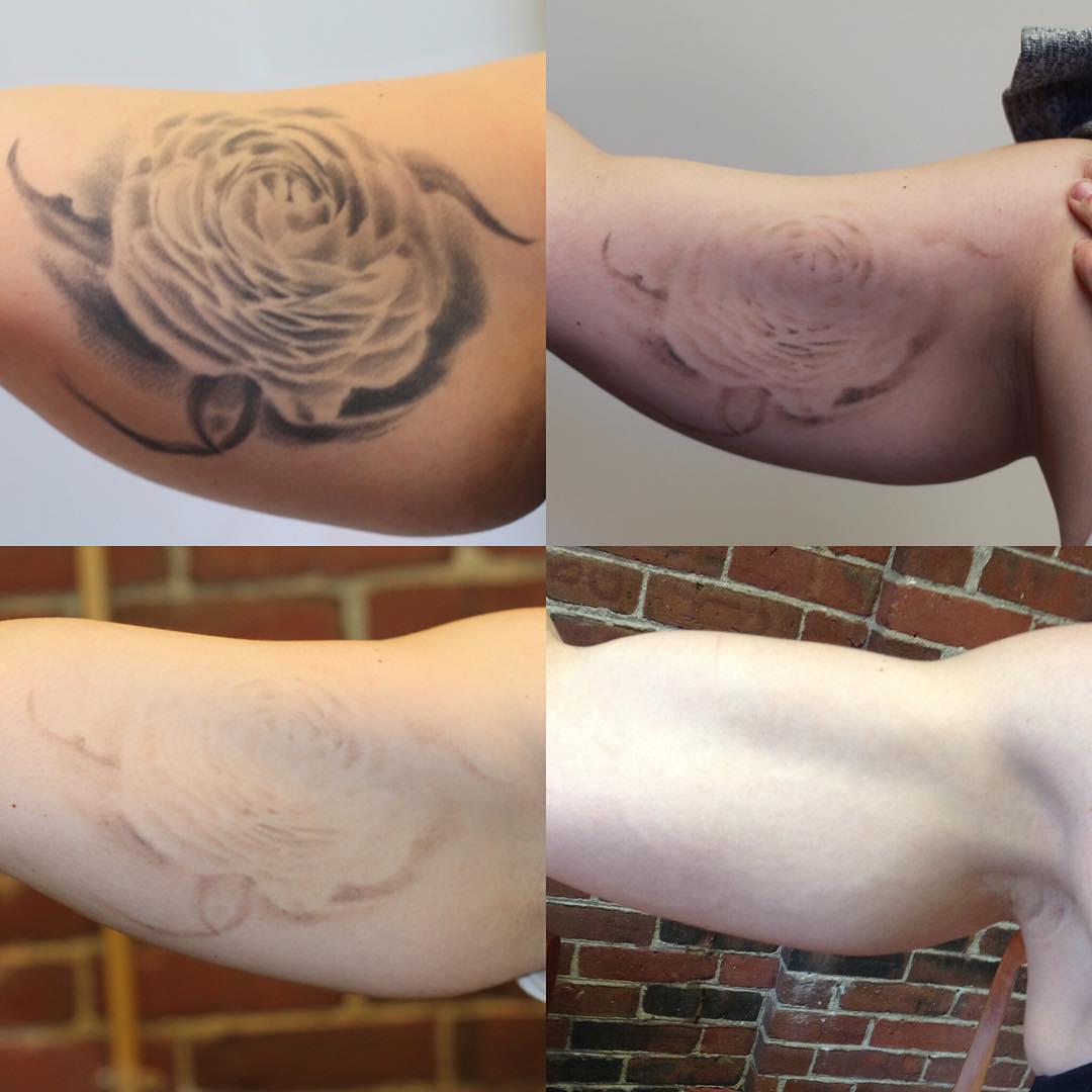 Removery Tattoo Removal & Fading à Ottawa: Before & After Upper Arm Tattoo Removal