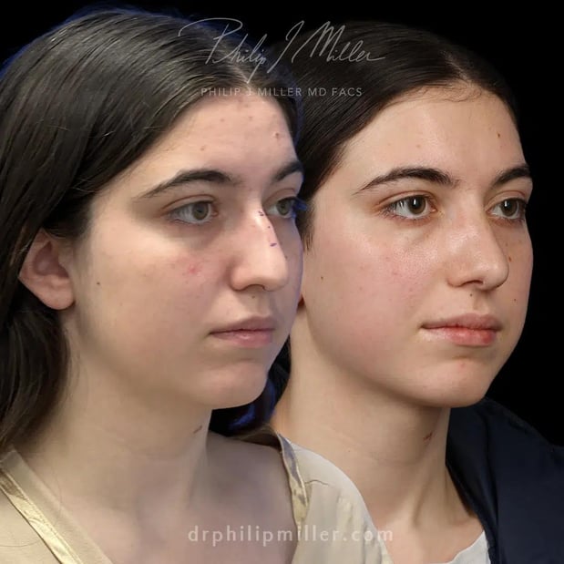Images Dr. Philip Miller - #1 Facelift and Rhinoplasty Surgeon in New York