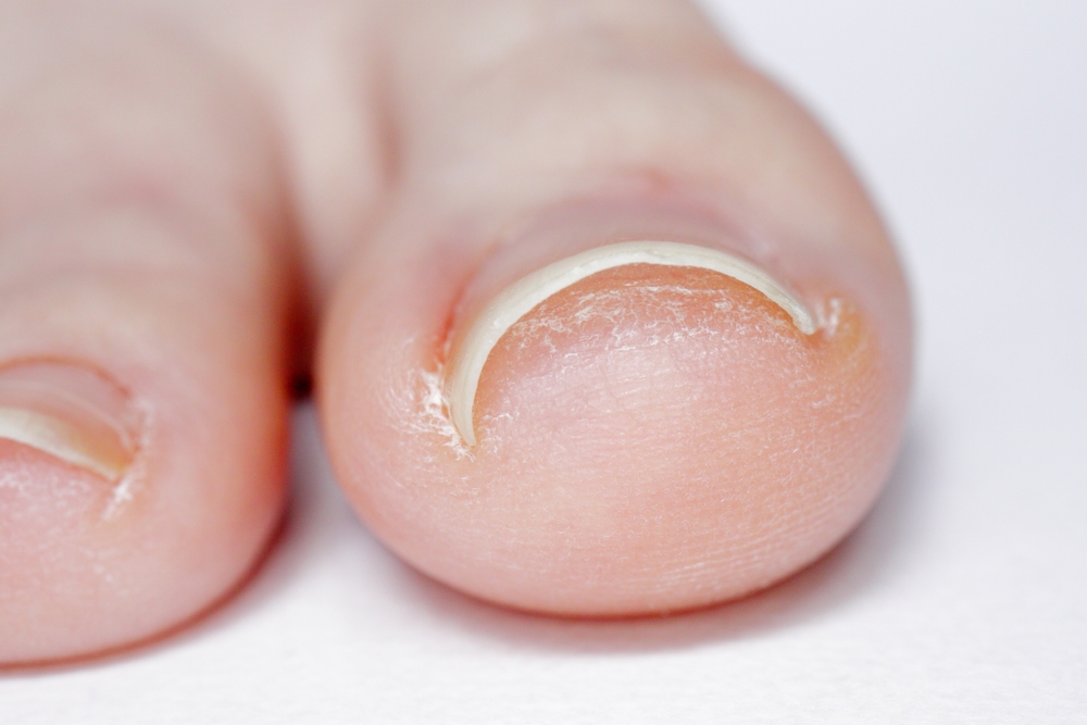 Conditions like ingrown toenails can quickly become painful and lead to infection if not handled properly. Westfield Foot and Ankle provides careful treatment designed to relieve discomfort and prevent recurrence. A podiatrist offering dependable foot care for Westfield, Carmel, Noblesville, Fishers, Northfield, Sheridan. Schedule a visit for relief.