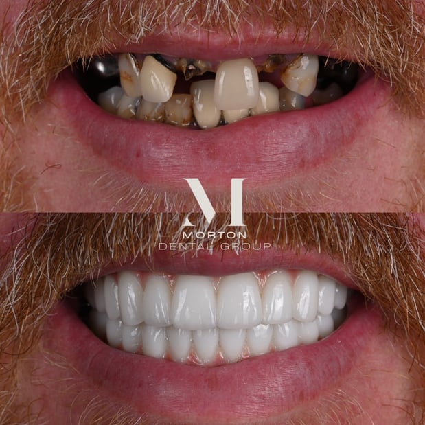 Images Nashville Wisdom Teeth and Implant Solutions