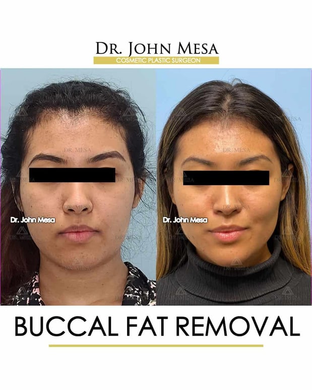Images Dr. John Mesa, MD: Plastic Surgeon NYC, Buccal Fat Removal, Chin Liposuction, Facelift, Facial Masculinization, Chin Implant