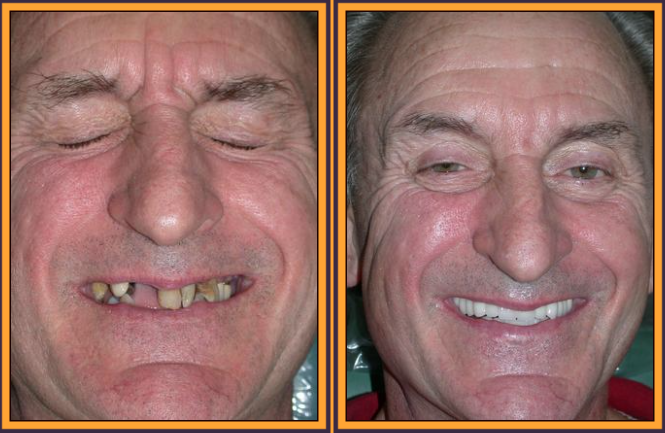 Before & After Results at Astoria Dental Group | Astoria, NY