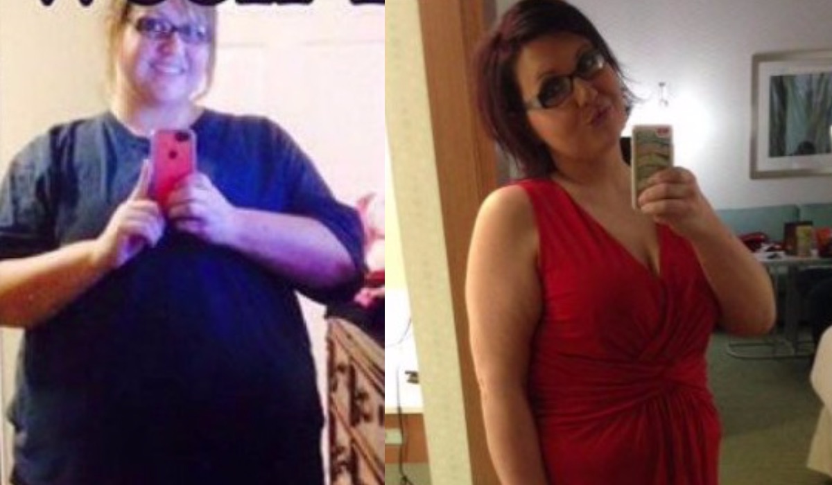 Before and After - Gastric Sleeve