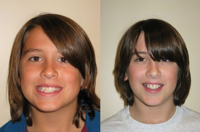 Before & After Results at Hulme Orthodontics | San Antonio, TX Hulme Orthodontics San Antonio (210)370-3083